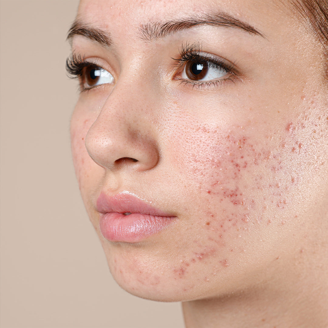 Pure Peel treatment before image – girl with acne-prone skin