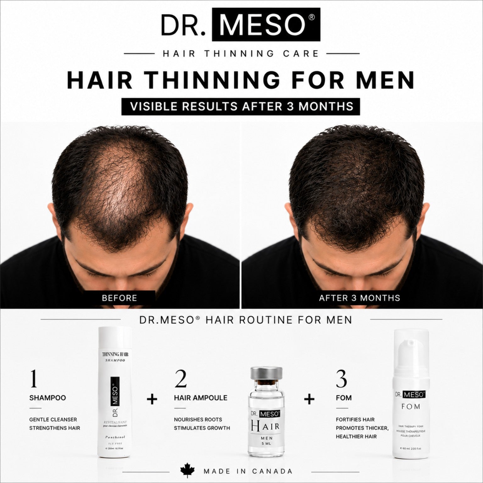 Training DR.MESO Thining Hair Program
