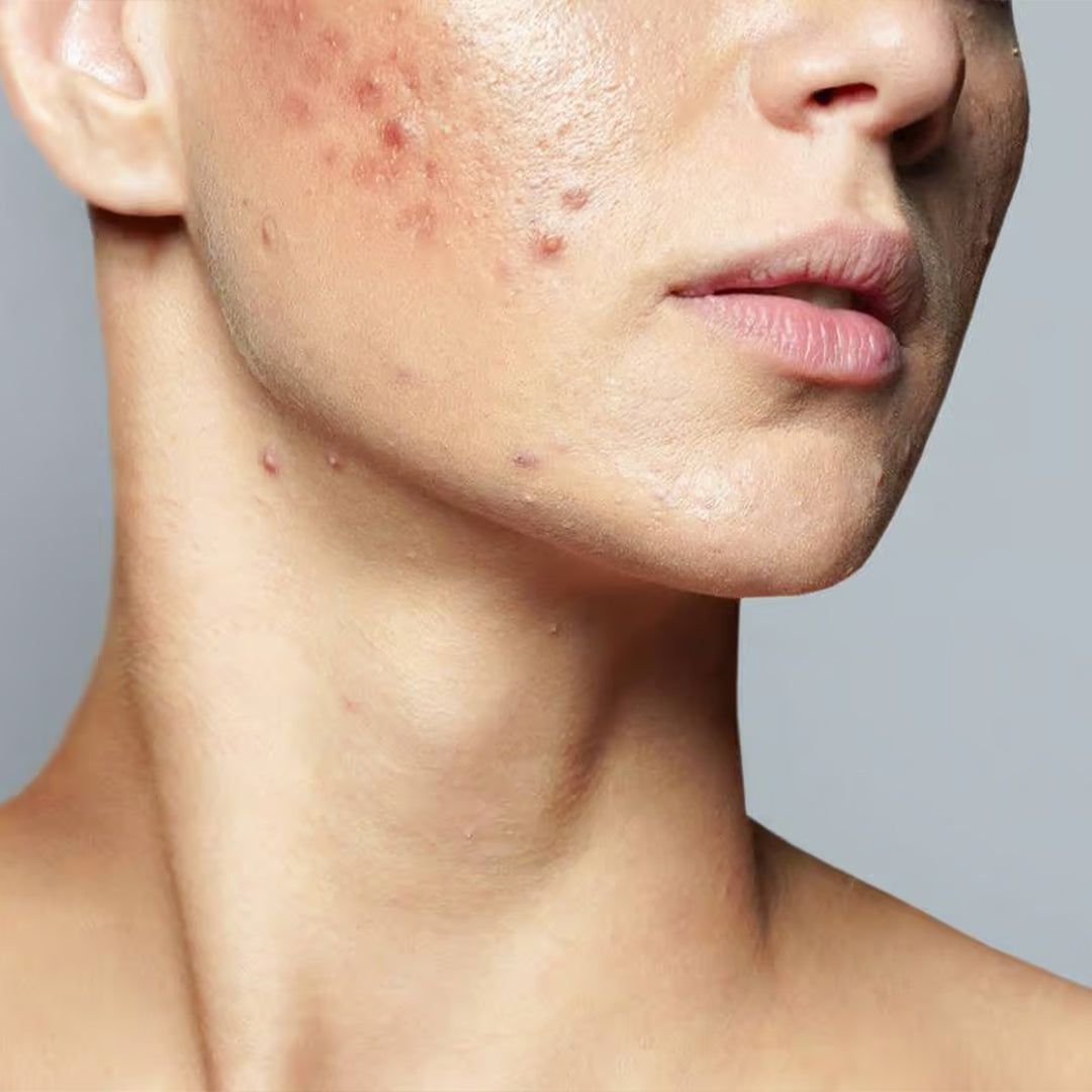 SPOT GEL  ACNE PRONE SKIN