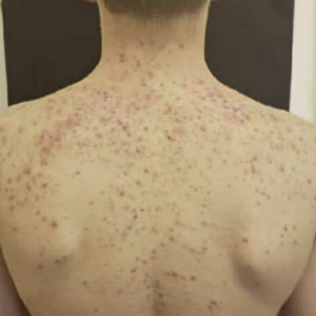 TRIPLE ACTION BODY CREAM - ACNE PRONE