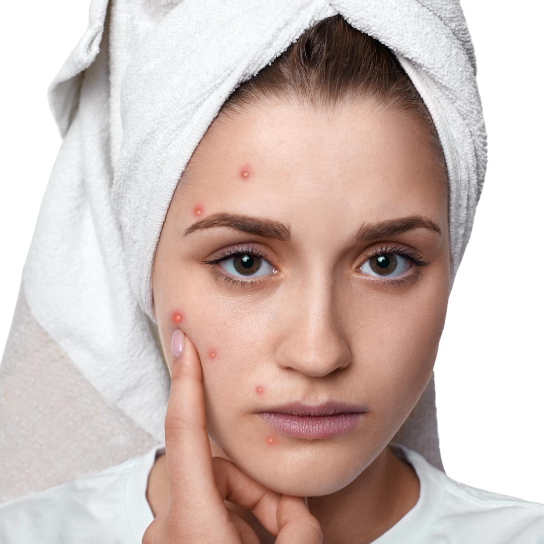 DAY CREAM - ACNE PRONE