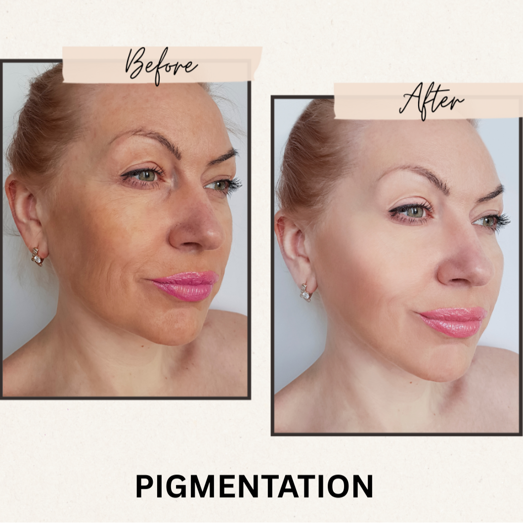 Before and after appearance of uneven pigmentation with DR.MESO brightening skincare routine