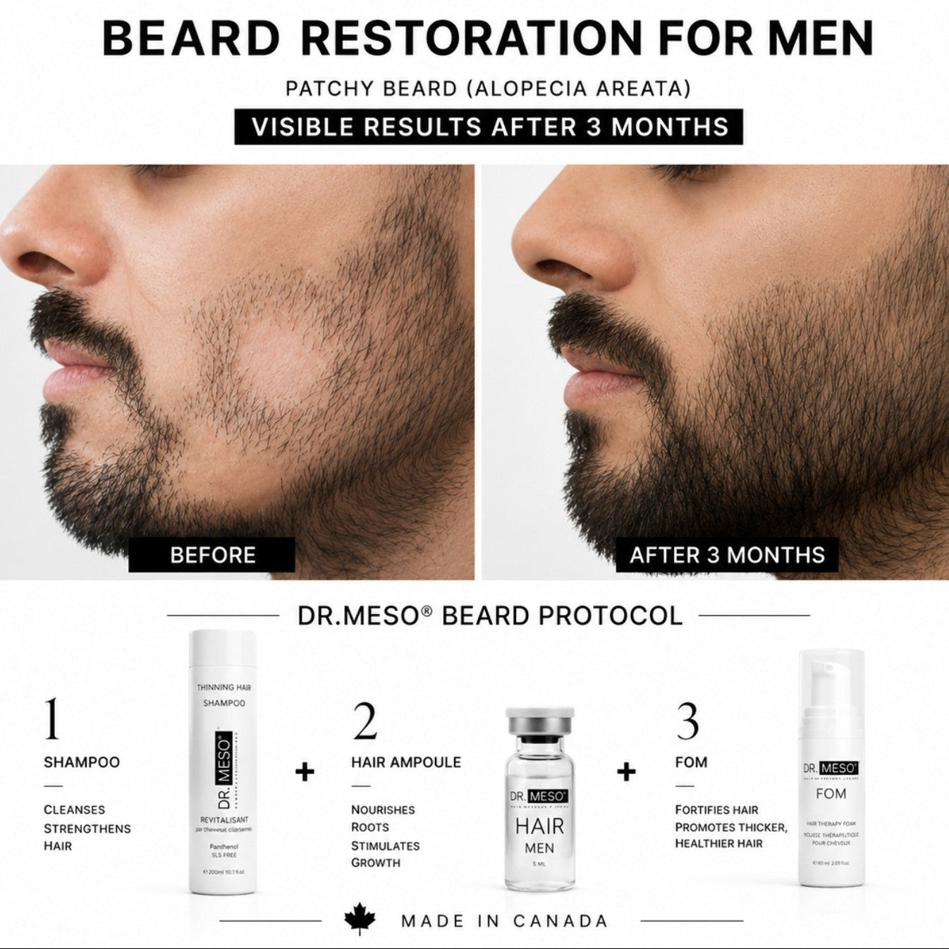 DR.MESO Beard Restoration for Men – patchy beard alopecia before and after 3 months using Hair Men protocol.