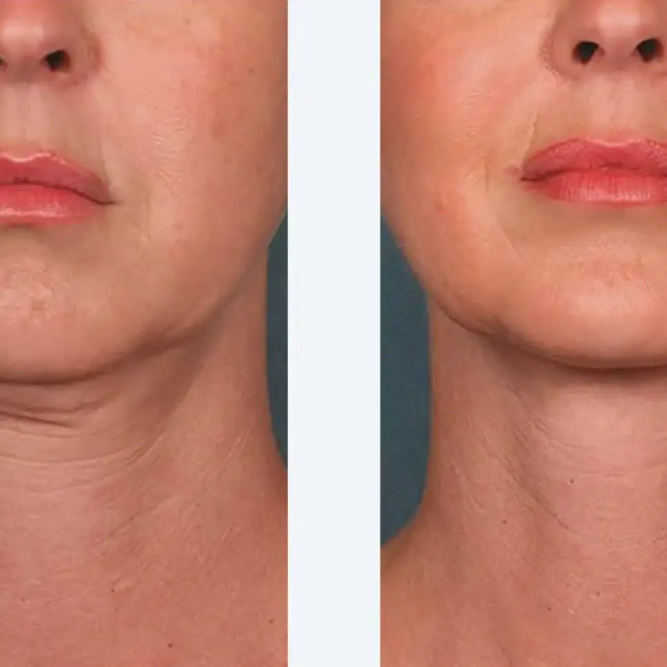 HYALURONIC ACID SERUM